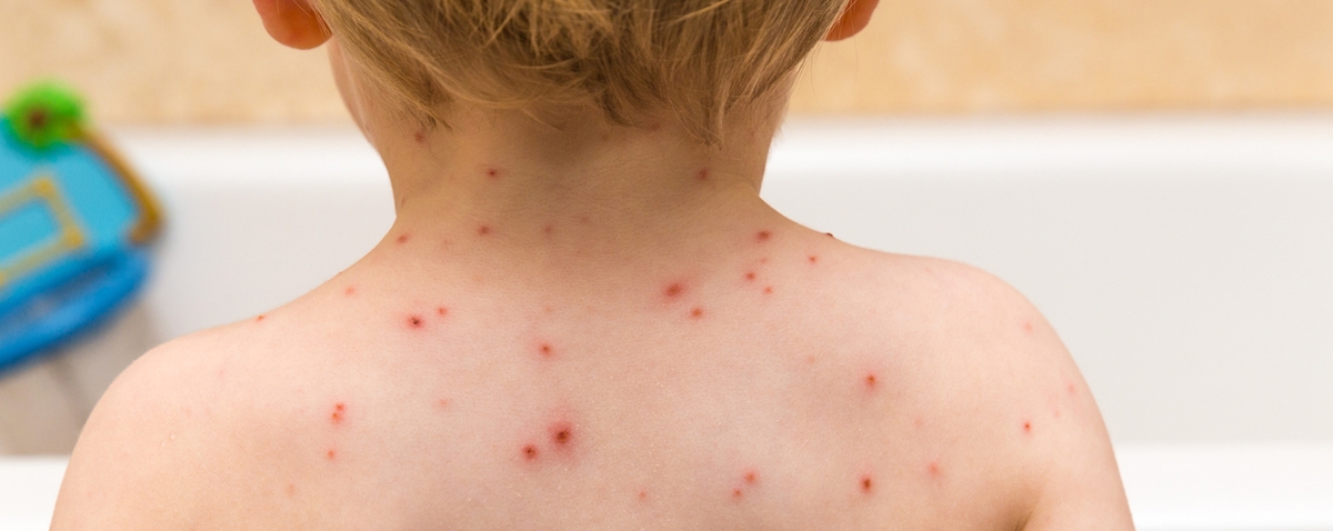 Chicken Pox on a toddler’s back