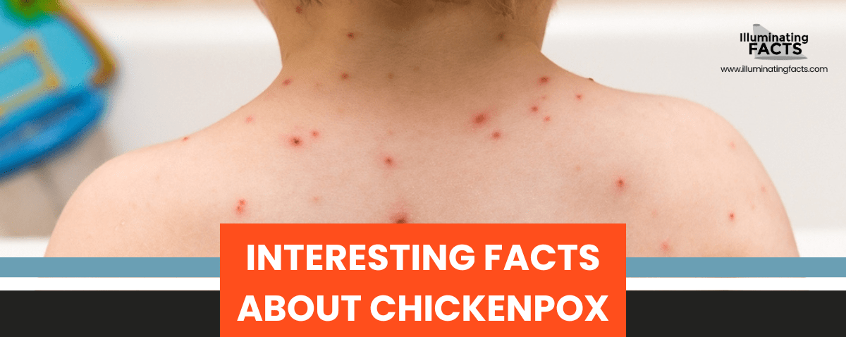 Interesting Facts about Chickenpox