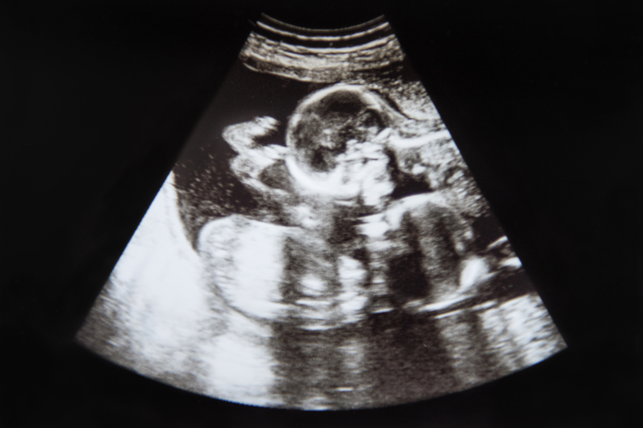 Baby Ultrasound Identical Twins