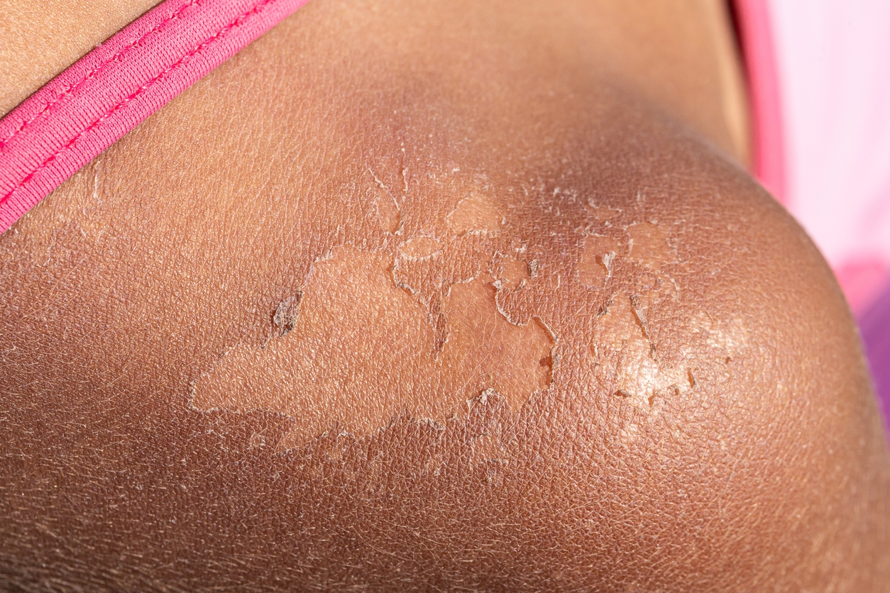 Dry and peeled skin on the shoulder of a young girl, effect of the sun's rays