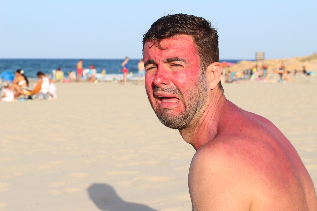 sunburned man in immense pain 